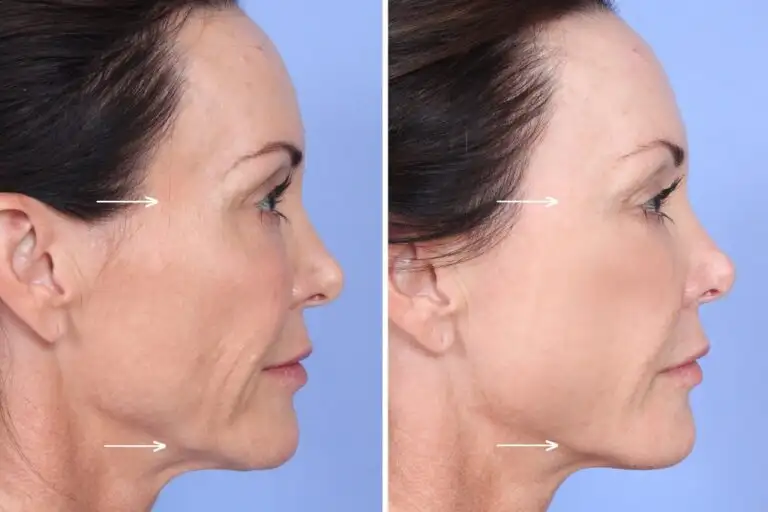 Sculptra vs. Surgical Facelifts in Malta