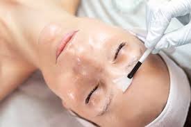 Chemical-Peel